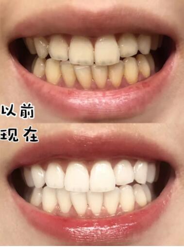 牙膏减少牙渍牙结石,去除牙菌斑清新口气牙膏