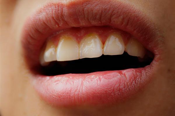 长期使用漱口水会有什么后果,漱口水是否可以频繁使用