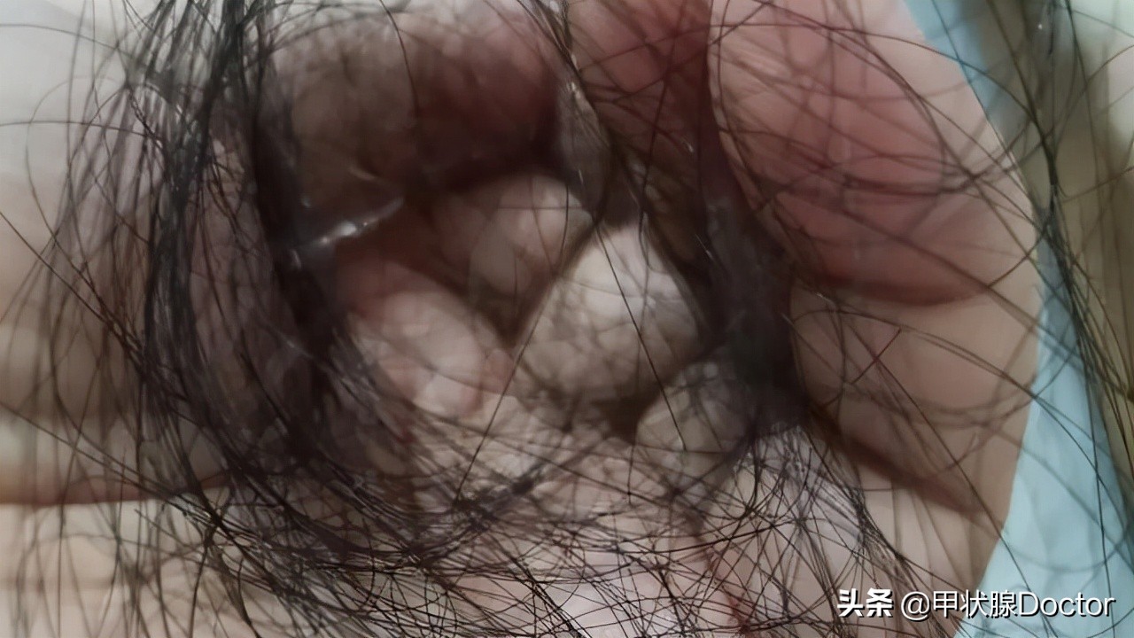 长期服用优甲乐的人要注意什么,吃优甲乐多久副作用能消失