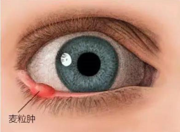 小孩麦粒肿和霰粒肿的区别,霰粒肿和麦粒肿是一样的吗