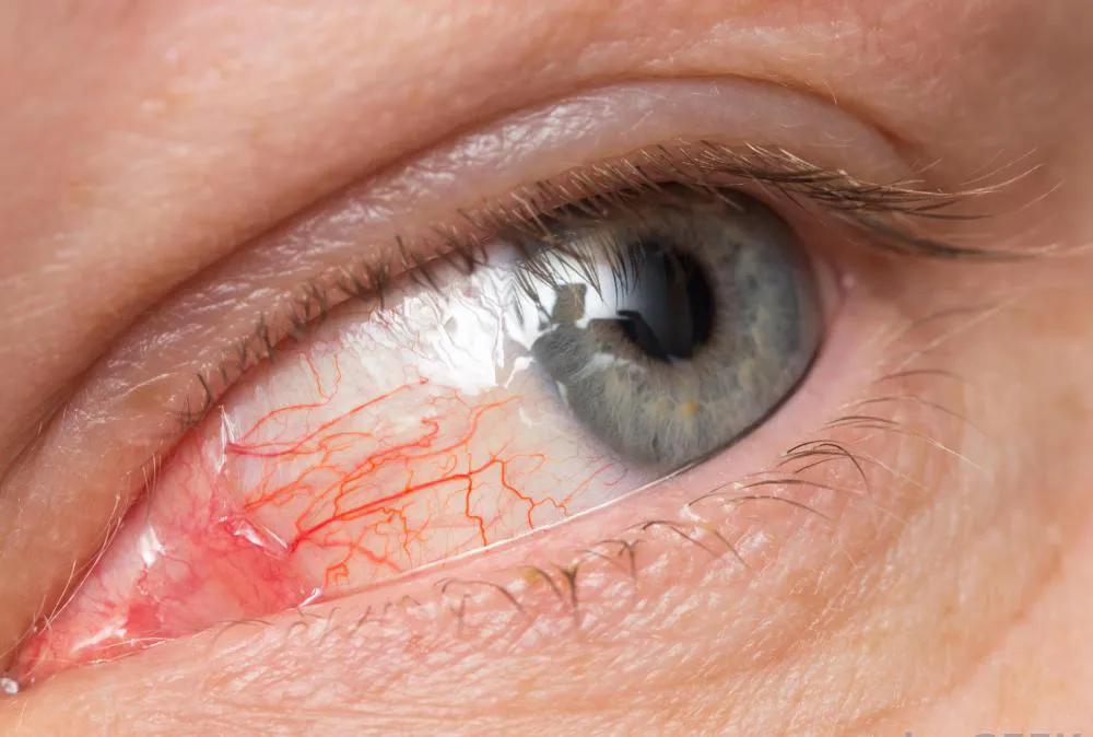 眼睛突然又红又肿是什么原因,眼睛又痒又痛又红又肿是什么原因