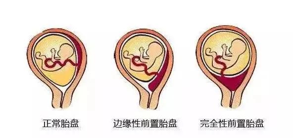 红兴隆中心医院成功实施第三胎完全性胎盘前置剖宫产手术