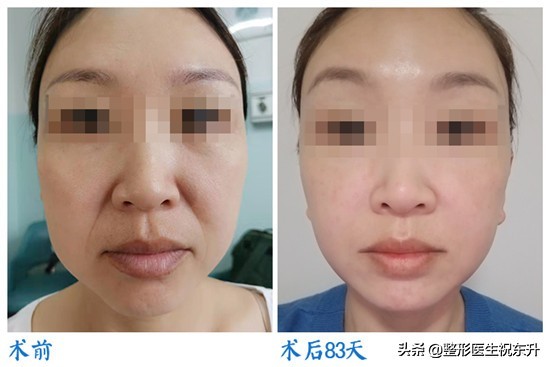 对比常做的几个面部提升项目,祝大夫面部提升