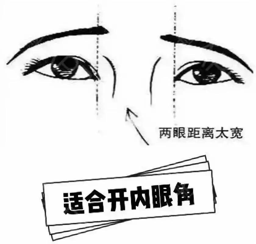 开眼角真的能变漂亮吗,开眼角能显眼睛大吗