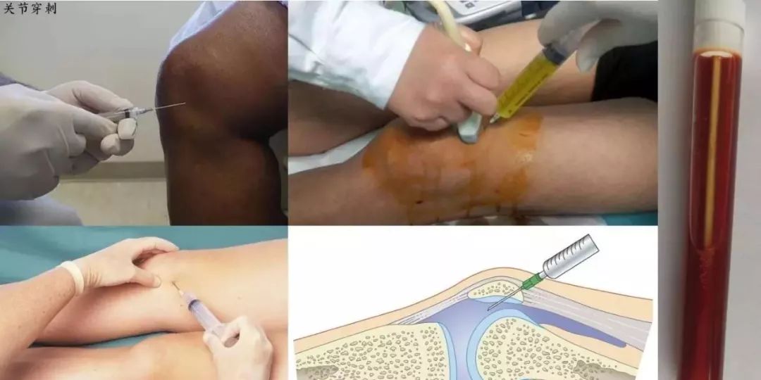 滑膜炎十大常见骨科疾病,骨科专家治滑膜炎偏方