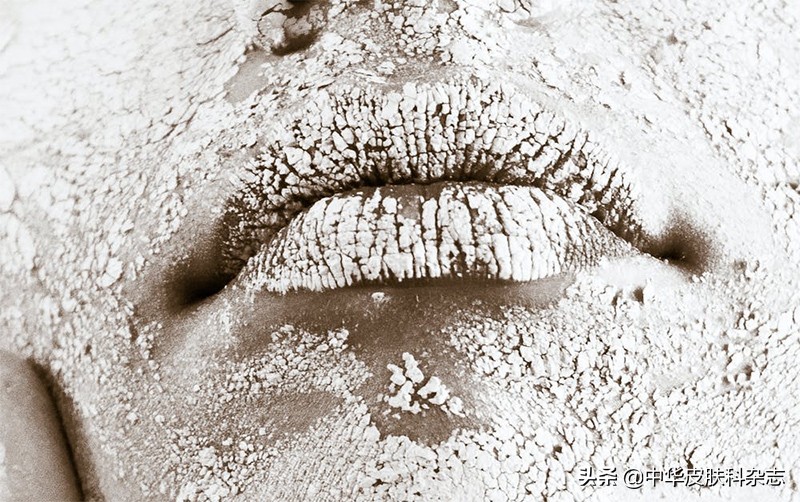 nb-uvb光疗仪使用方法,nbuvb紫外线光疗仪作用