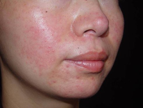 这几种面膜不能买小心烂脸,买错医美面膜当心会烂脸