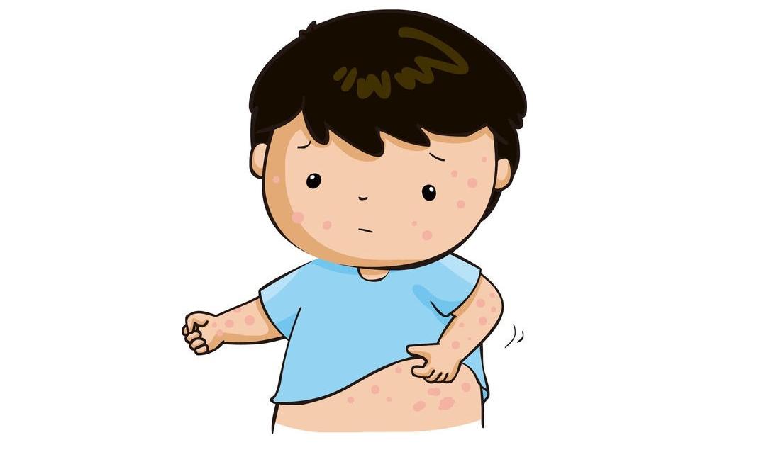 什么是过敏性紫癜有什么症状,什么是过敏性紫癜的表现