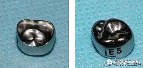 预成冠儿童乳牙内收钳怎么用,乳牙金属预成冠有必要做吗