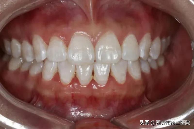 常见牙齿美白方式大盘点,牙齿美白性价比最高的方法
