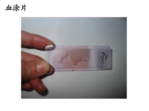 白细胞升高一定不是病毒感染吗,白细胞假性升高原因