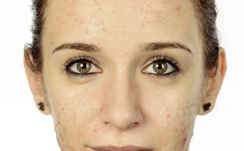 如何去除痘印,挤破痘痘后怎么处理才会不留痘印