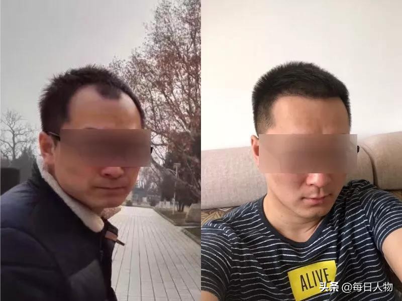 脱发知识普及,当代脱发现状