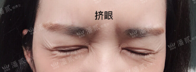 10个工作室做，9个毁，祛眼袋连卧蚕也没了，直接送我到10年后