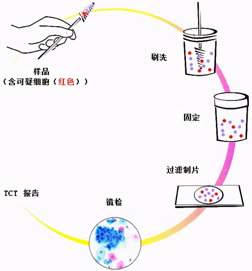 TCT、阴道镜、CIN、锥切（leep）都是什么意思？