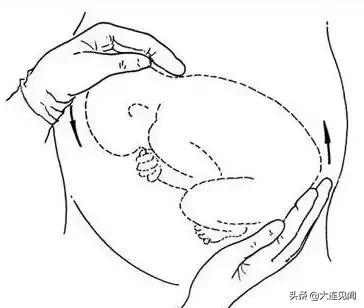 臀位宝妈们的福音——不断突破“极限”的臀位外倒转术