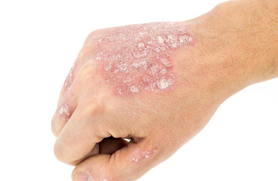 银屑病严重瘙痒怎么办,寻常型银屑病瘙痒多吃黑葡萄好吗