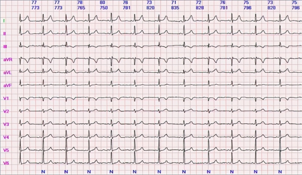 心脏彩超和动态心电图哪个准确,心电图跟心脏彩超哪个更准确