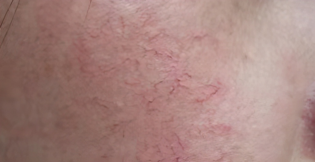 光子嫩肤祛红血丝最好的方法,光子嫩肤去红血丝脸颊泛红