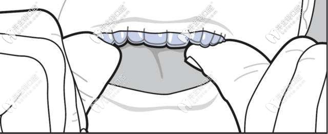 南京整牙哪家医院好多少钱,南京成人隐形整牙多少钱