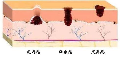 眼睛有泪痣人中有痣是不是不好,泪痣代表什么面部哪些痣必须点掉