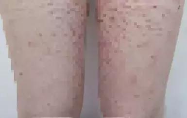 网购神药含激素，5岁女儿浑身红斑长毛！一抹就灵的药要警惕！