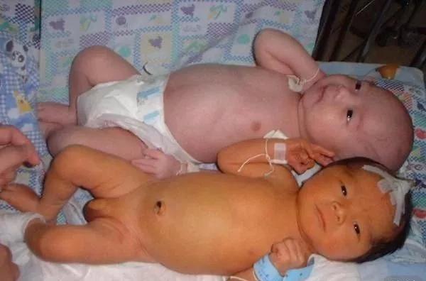 新生儿的几种生理现象图片,新生儿正常生理现象