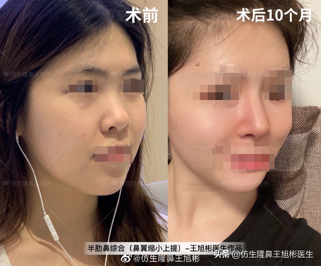 那些被鼻子“封印”颜值的鼻综合/修复案例|广州鼻整形