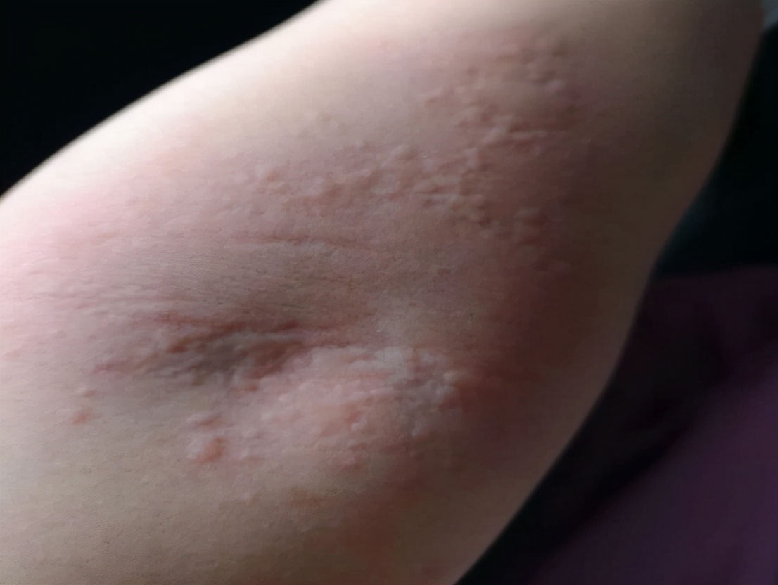 荨麻疹缓解瘙痒的方法是什么,荨麻疹瘙痒难忍可以用什么缓解