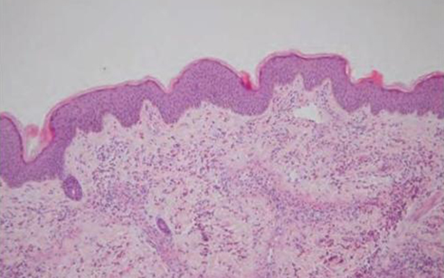 过敏性紫癜还有皮疹可以出院吗,过敏性紫癜皮疹下去多久能上学