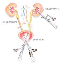 泌尿系结石手术治疗,哪种手术治疗尿路结石