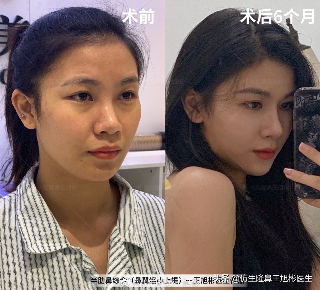 那些被鼻子“封印”颜值的鼻综合/修复案例|广州鼻整形