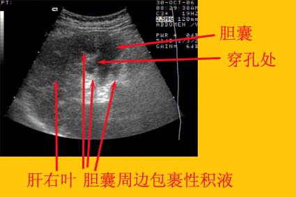 又有胃病又有胆结石怎样注意饮食,胆结石引起的胰腺炎饮食注意什么
