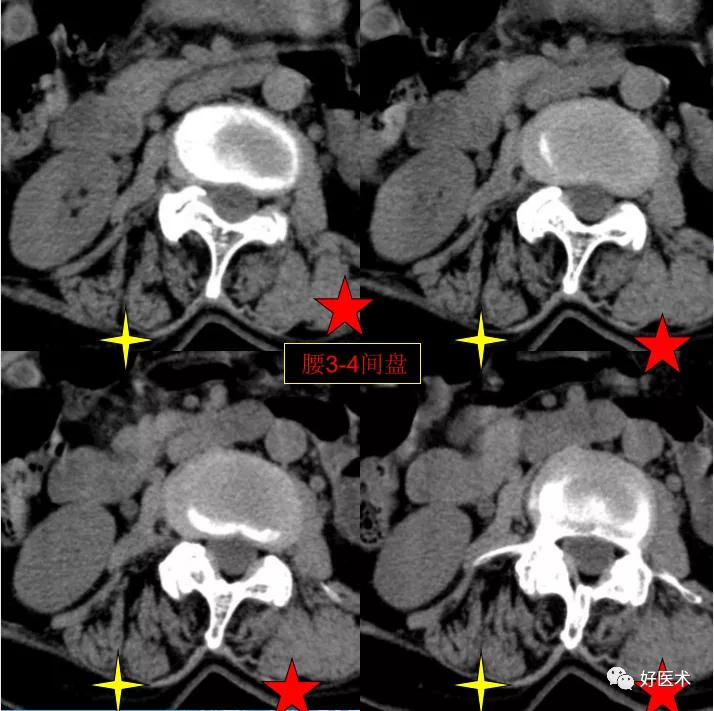 腰部ct需要注意事项,做腰部ct需要注意的事项