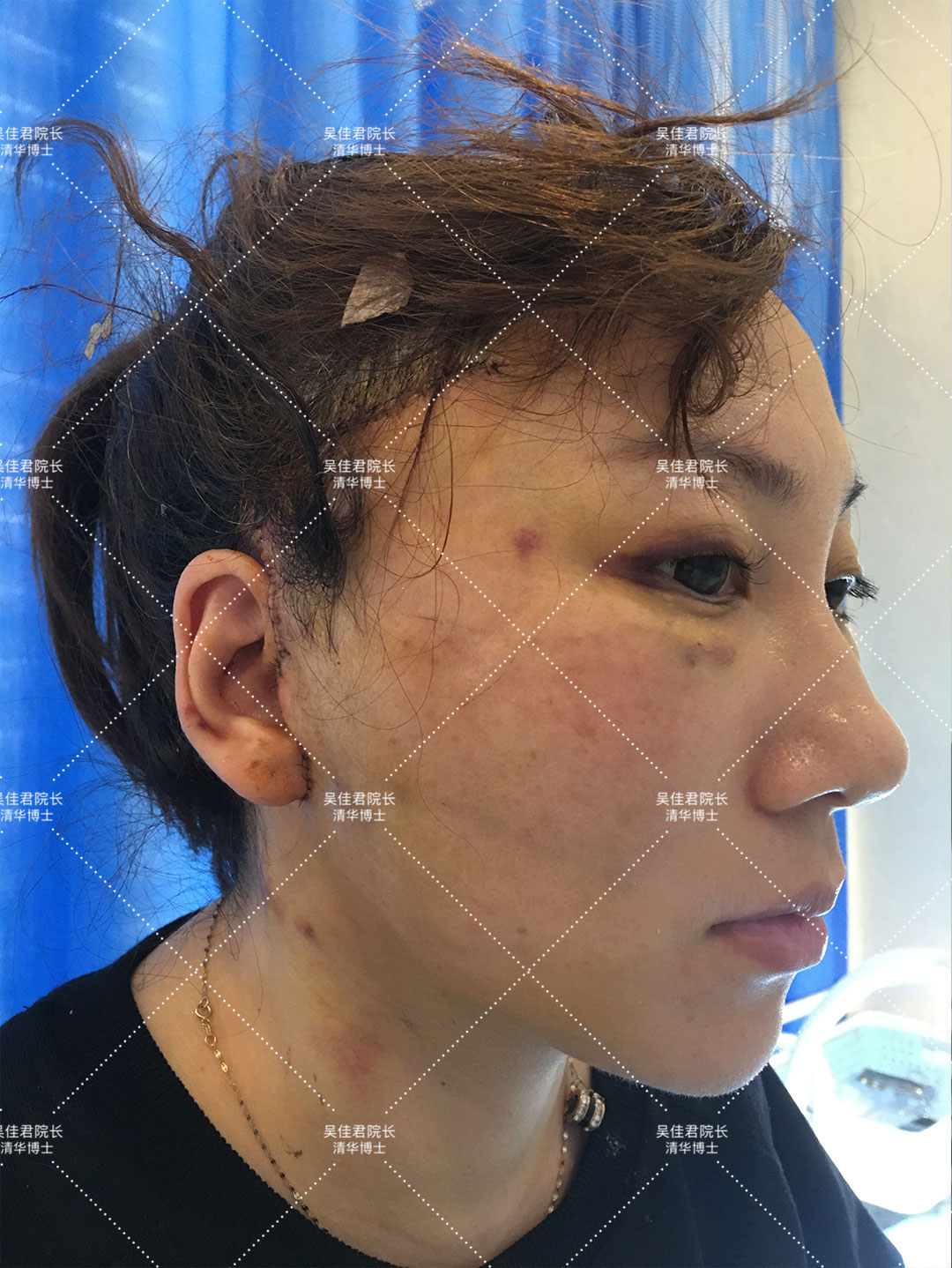 做一个拉皮手术人可以年轻多少岁,做拉皮的真实感受