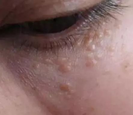 脂肪粒的形成是因为缺少维生素嘛,眼周围的脂肪粒的形成原因是什么