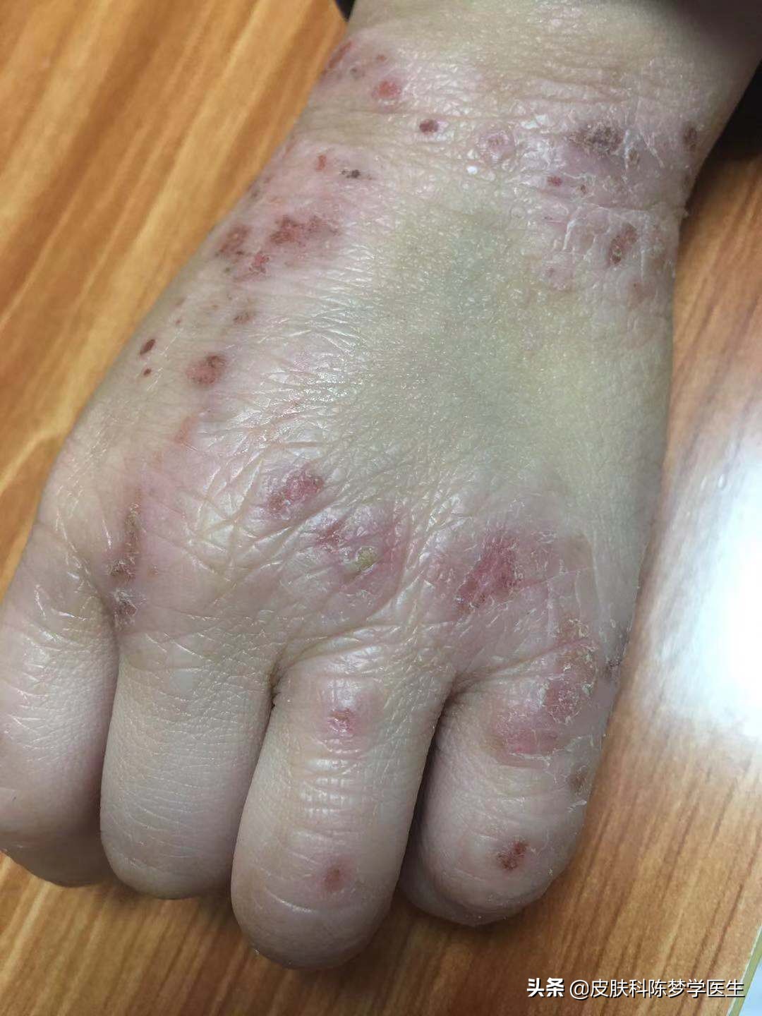 皲裂性湿疹怎么治,湿疹能不能治得好