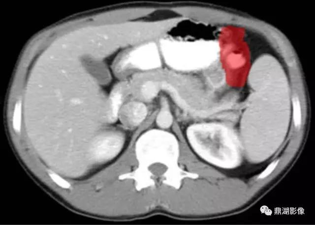颈部胸锁乳突肌ct断层解剖图,骨盆骨质正常断层ct解剖图解
