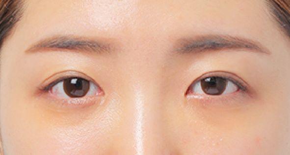 血管型黑眼圈怎么消除,戴眼镜黑眼圈怎么消除