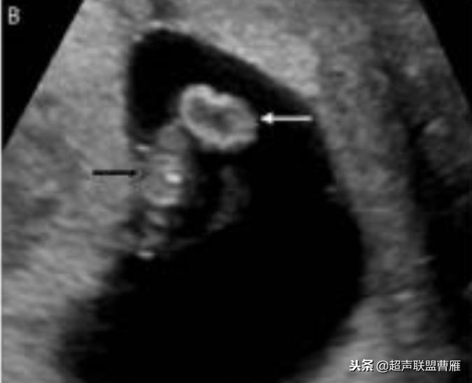 内见卵黄囊,卵黄囊肿瘤