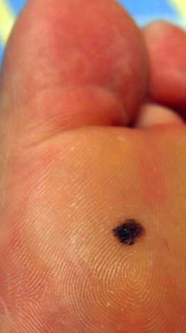 你身上的痣是什么,你身上的痣代表什么