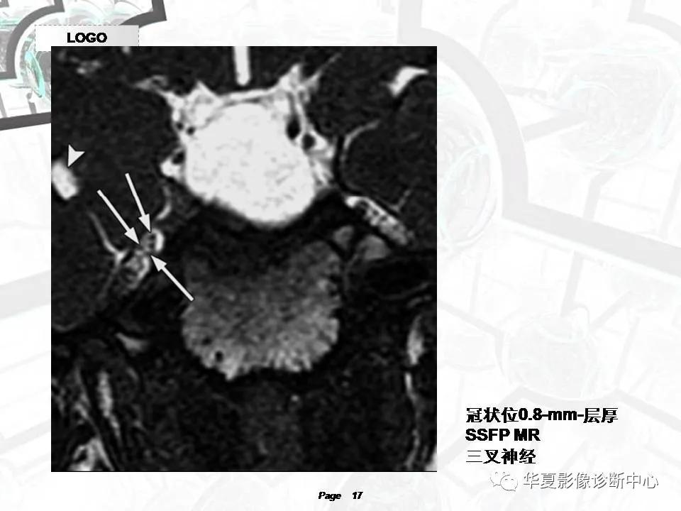 磁共振颅神经扫描是定位在哪,颅神经图谱