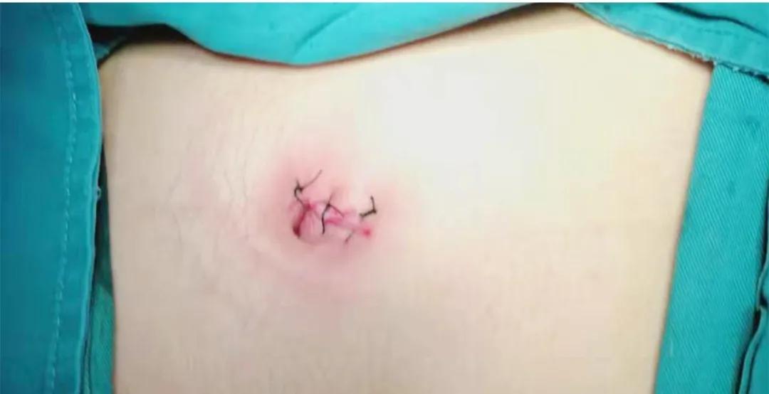 腹腔镜胆囊切除术病例分析,我院完成腹腔镜胆囊切除术