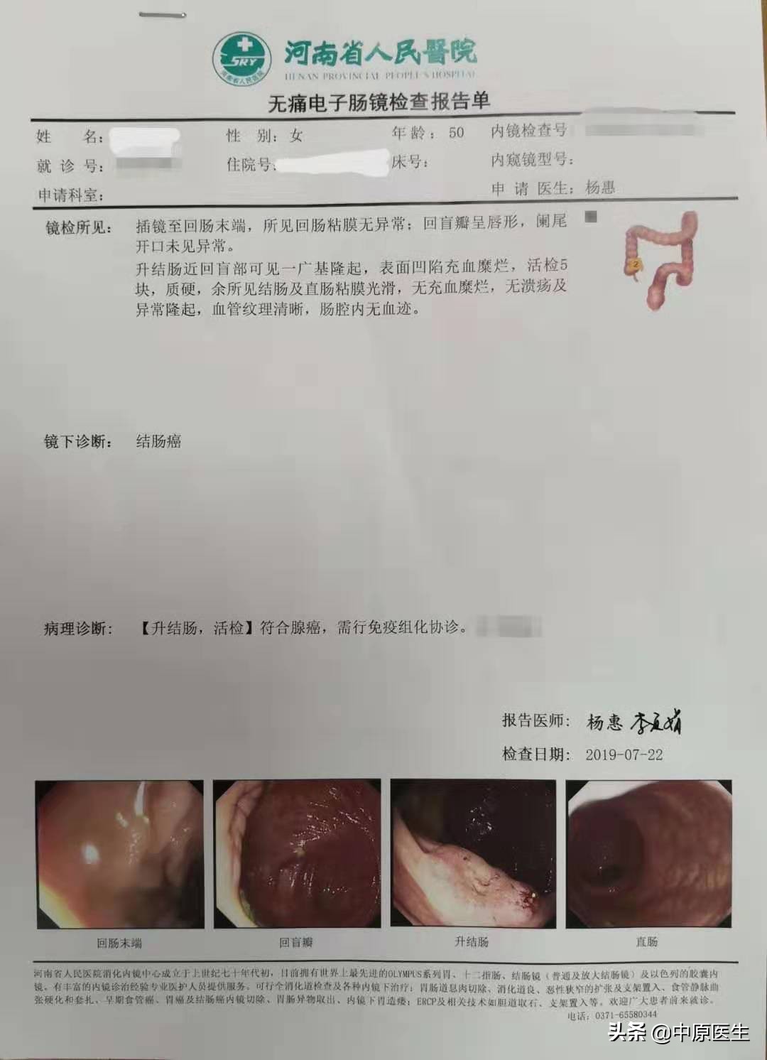 做胃息肉切除时省级专家反复劝说患者顺便做一下胃肠镜，发现腺癌