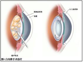 科普|“雾里看花”为哪般