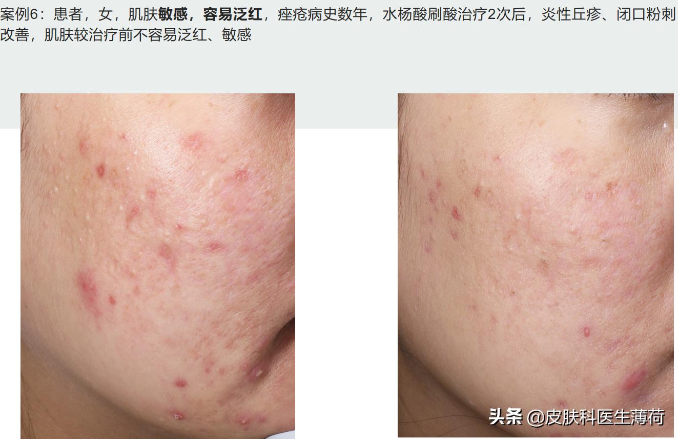 修复痘坑水杨酸果酸哪种好用,刷酸去闭口水杨酸敏感肌