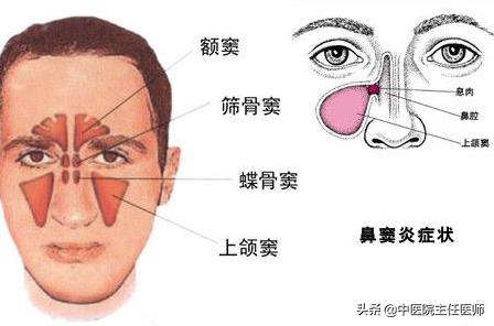 鼻窦炎引发的头疼严重吗,鼻窦炎发展到什么程度会引起头疼