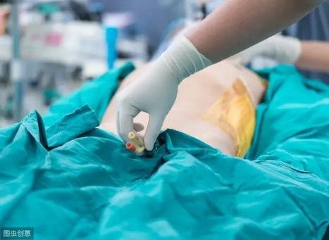 哪些手术需要插导尿管？下导尿管是什么感觉？