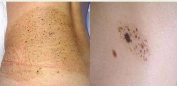 雀斑样痣是雀斑的一种吗,雀斑痣和健康痣有什么区别