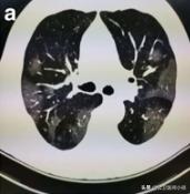 新型冠状病毒肺炎患者的肺,新型冠状病毒患者肺部体征